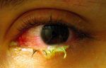 Swollen_eye